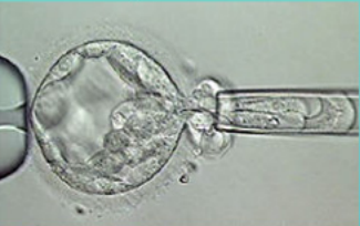 Биопсия клеток трофэктодермы у эмбриона 5 дня развития